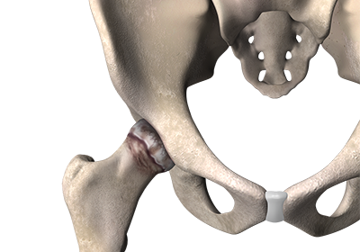 Diseased Hip